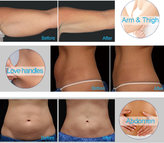 Double Chin Removal 690nm Fda Approved Cryolipolysis Machine 5