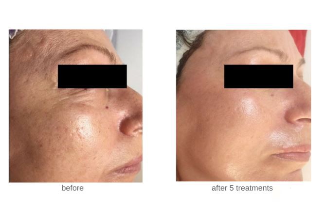 microneedle-fractional-rf before after4