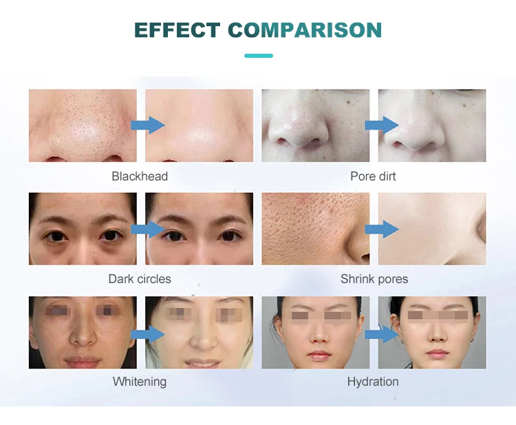 blue ice hydrofacial machine4