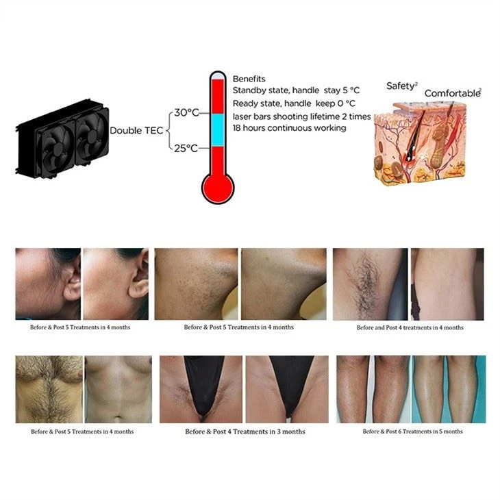 Professional Painless Hair Removal Machine