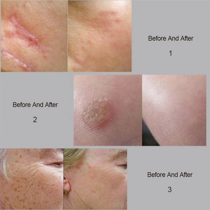 KES Co2 Fractional Laser Machine